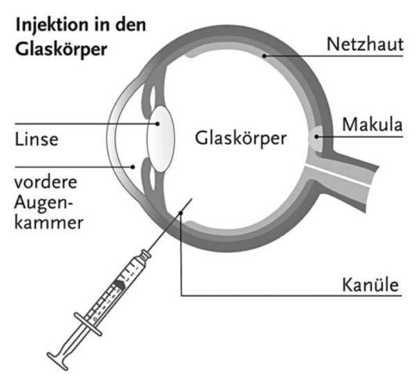 Grafische Darstellung eines Auges während der Spritzentherapie